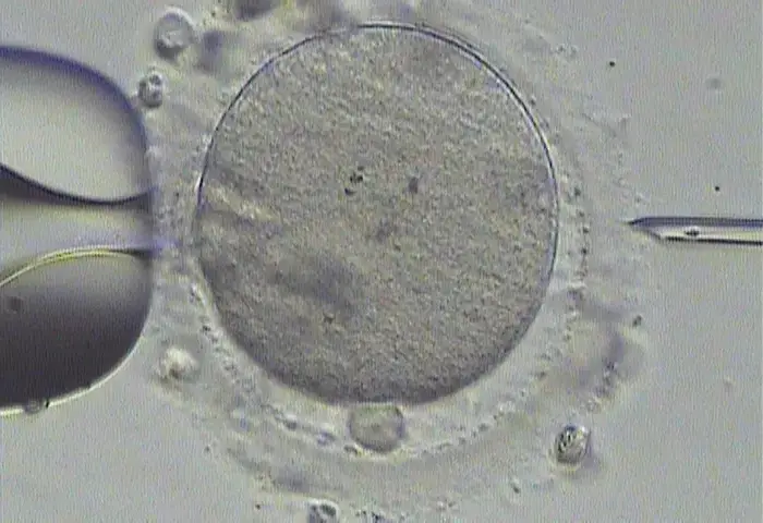 Tecnica dell'ICSI, iniezione intracitoplasmatica dello spermaztozoo